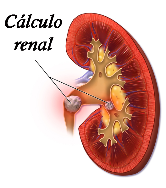 Calculorenal