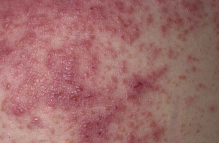 Dermatitis herpetiformis2