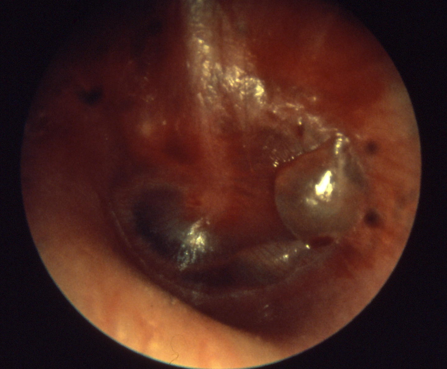 Otitis media bullös