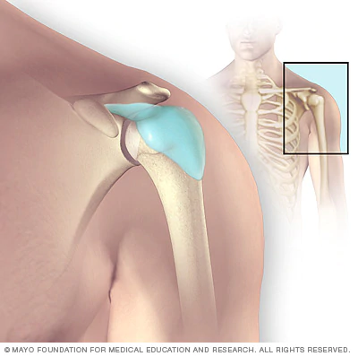 bursitis