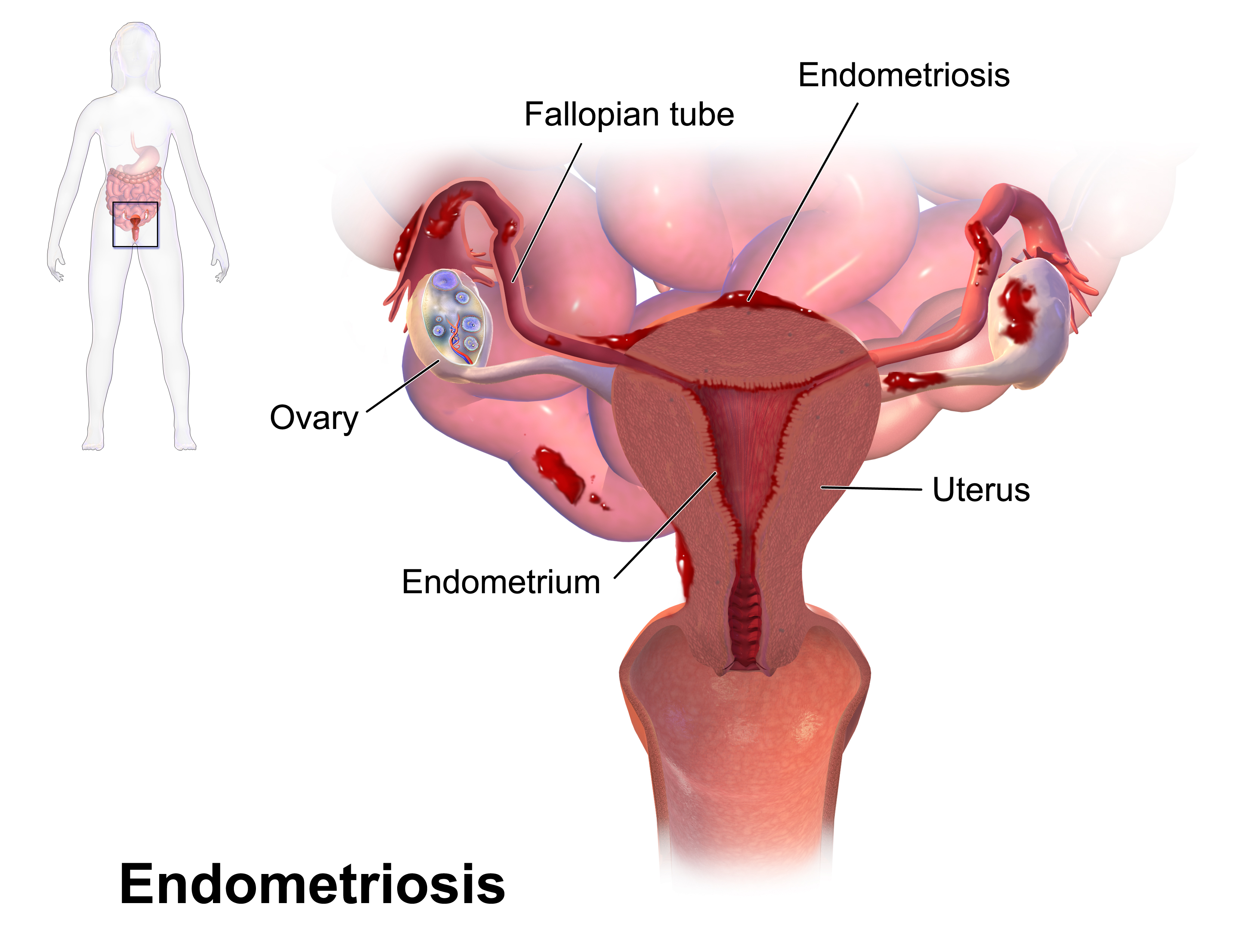 endometriosis