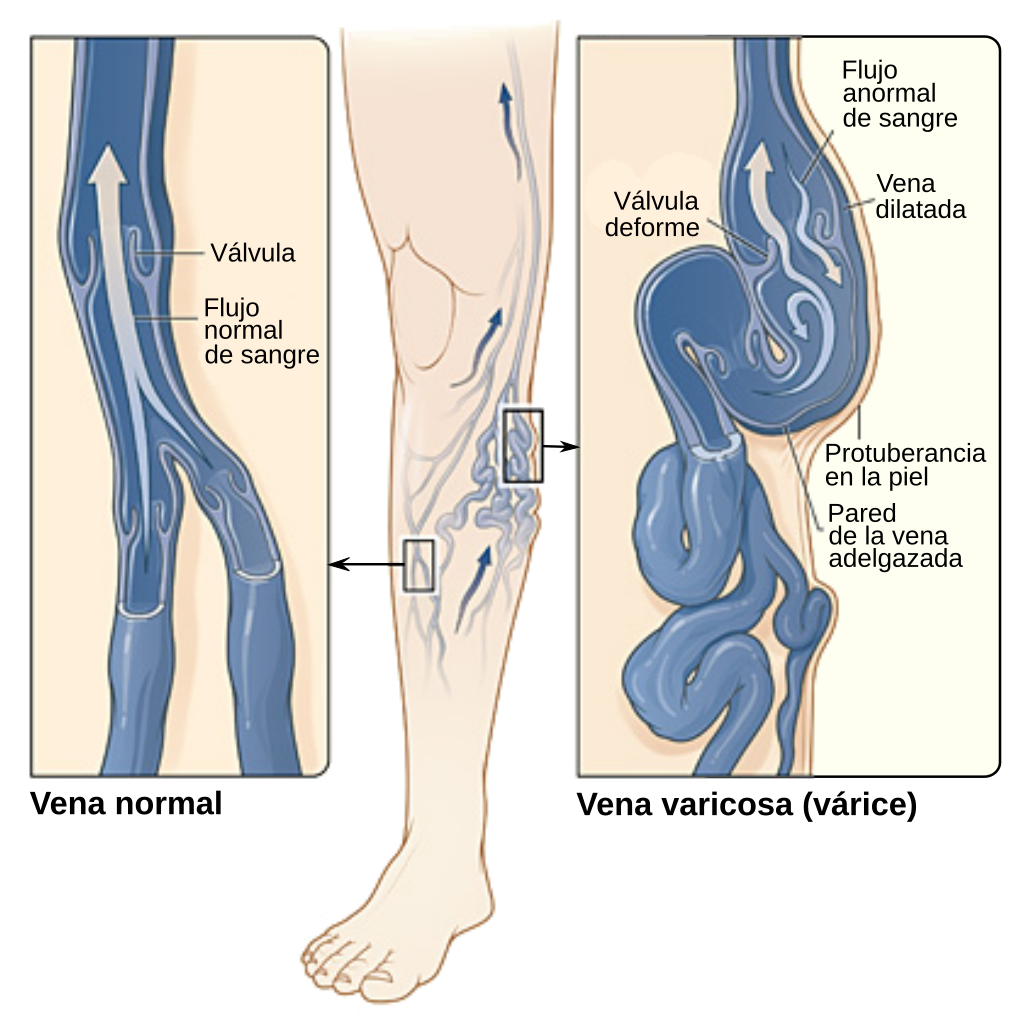 varices